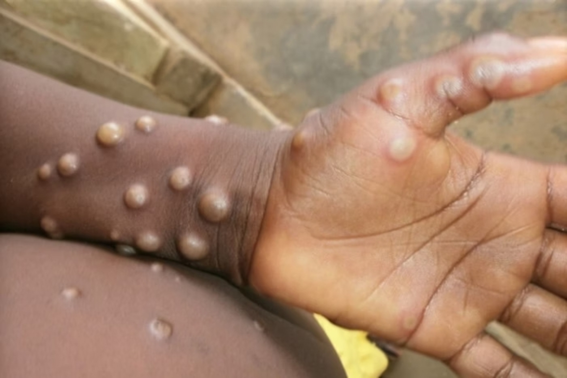 Entre os sintomas da Mpox estão bolhas no corpo